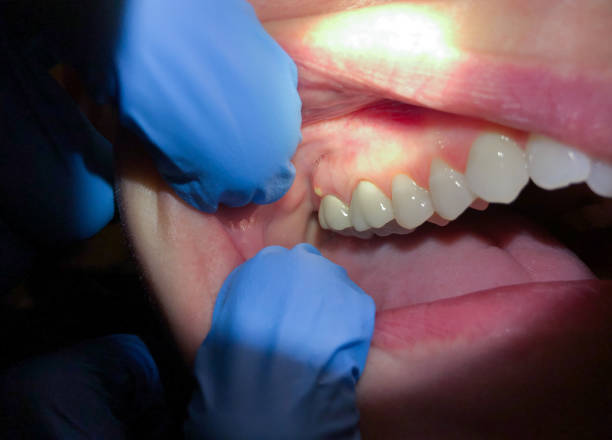 Best Knocked-Out Tooth (Avulsed Tooth) Treatment in Hanscom Af, MA